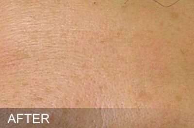 HydraFacial Before & After Photos