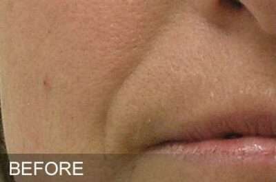 HydraFacial Before & After Photos