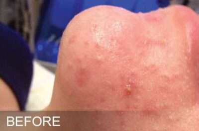 HydraFacial Before & After Photos