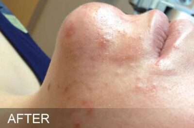HydraFacial Before & After Photos