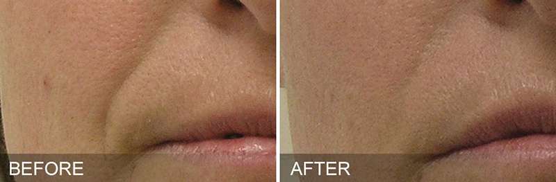 Hydrafacial Results San Ramon