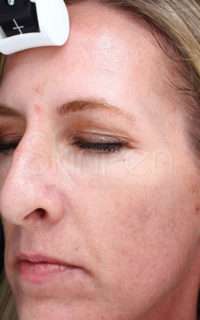 Skin Microneedling Before & After Photos