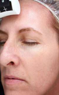 Skin Microneedling Before & After Photos