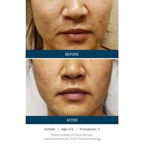 Skinpen Microneedling Results San Ramon