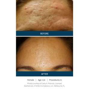 Skinpen Microneedling Results San Ramon