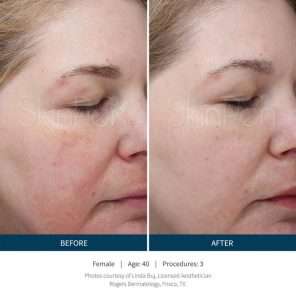 Skinpen Microneedling Results San Ramon