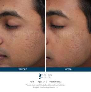 Skinpen Microneedling Results San Ramon