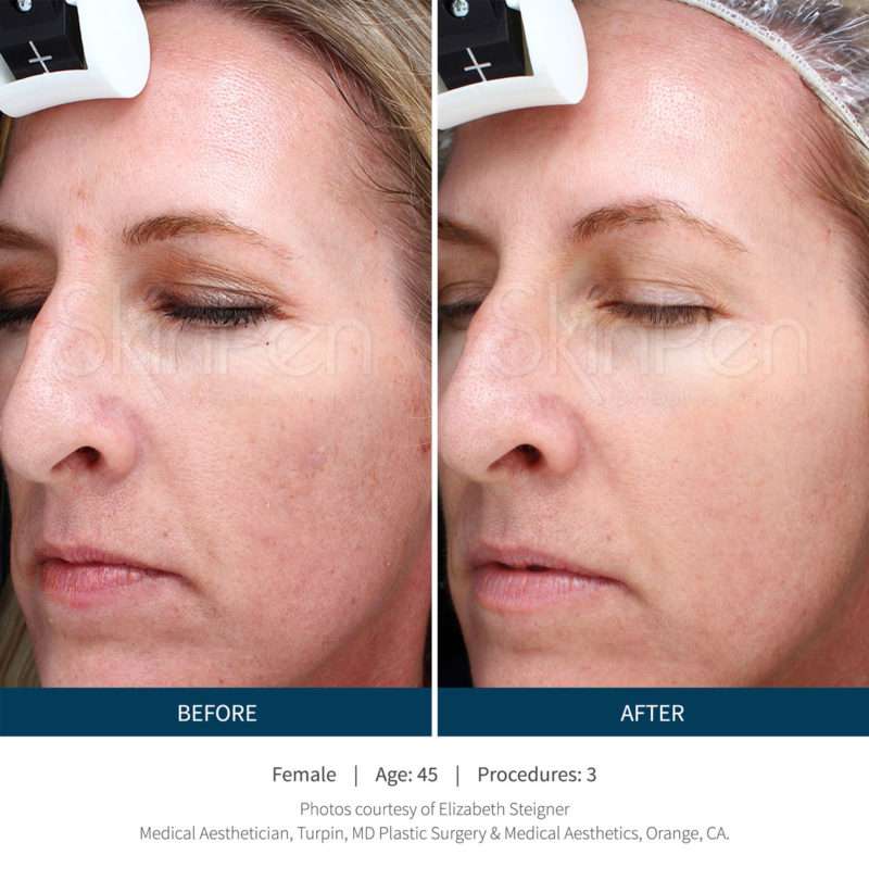 Skinpen Microneedling Results San Ramon