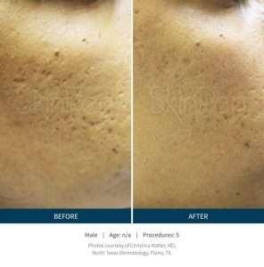 Skinpen Microneedling Results San Ramon