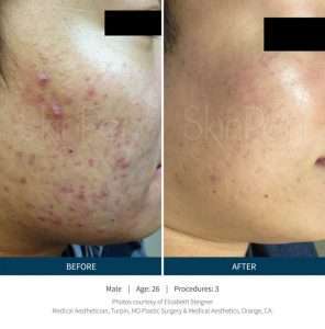 Skinpen Microneedling Results San Ramon