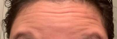Botox Before & After Photos