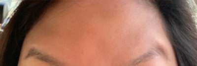 Botox Before & After Photos