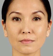 Fillers After Procedure