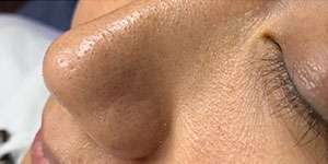 HydraFacial Before & After Photos