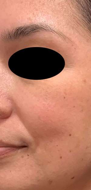 Botox Before & After Photos
