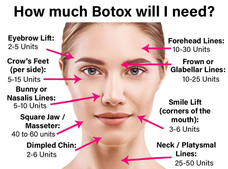 How much Botox do I need?