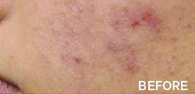 RF Microneedling Before and After Results