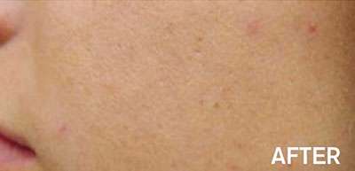 RF Microneedling Before and After Results