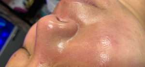 HydraFacial Before & After Photos
