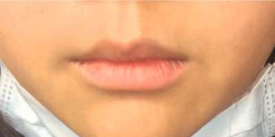 Dermal Fillers Before & After Photos