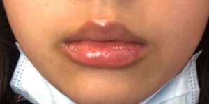 Dermal Fillers Before & After Photos