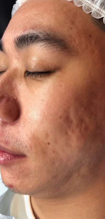 Skin Microneedling Before & After Photos