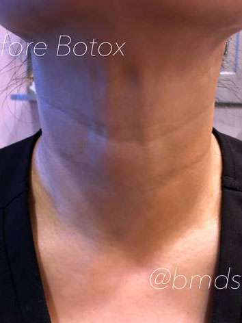 Botox Before & After Photos