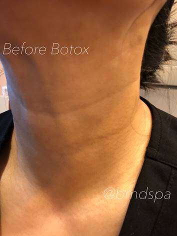 Botox Before & After Photos
