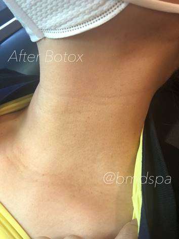 Botox Before & After Photos
