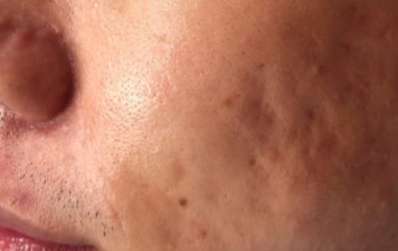 Skin Microneedling Before & After Photos