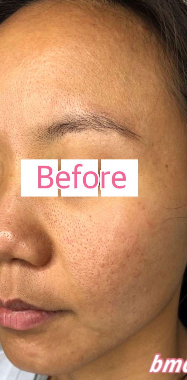 RF Microneedling Vivace Results San Ramon