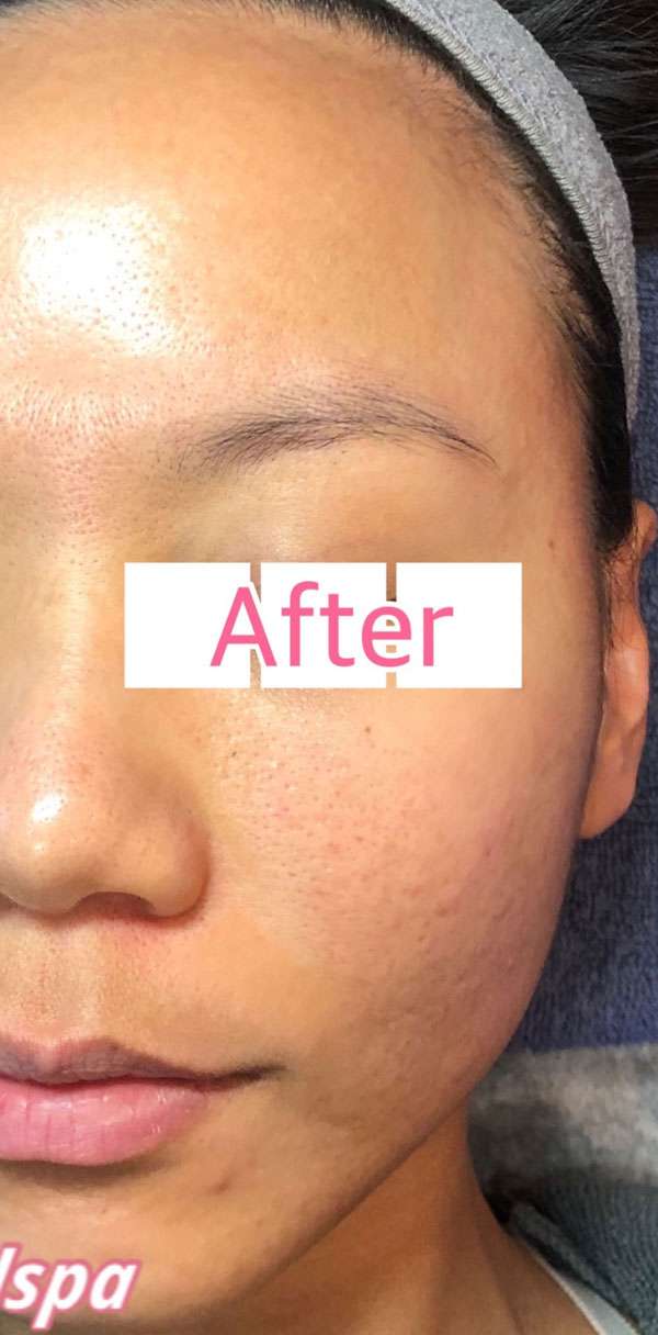 RF Microneedling Vivace Results San Ramon