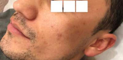Skin Microneedling Before & After Photos