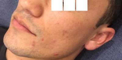 Skin Microneedling Before & After Photos