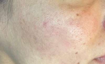 Skin Microneedling Before & After Photos