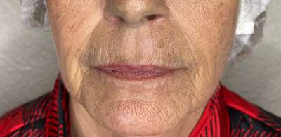 PDO Thread Lift Before & After Photos