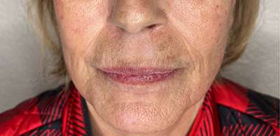 PDO Thread Lift Before & After Photos