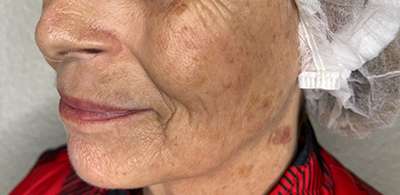 PDO Thread Lift Before & After Photos
