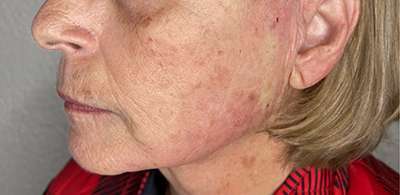 PDO Thread Lift Before & After Photos