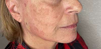 PDO Thread Lift Before & After Photos