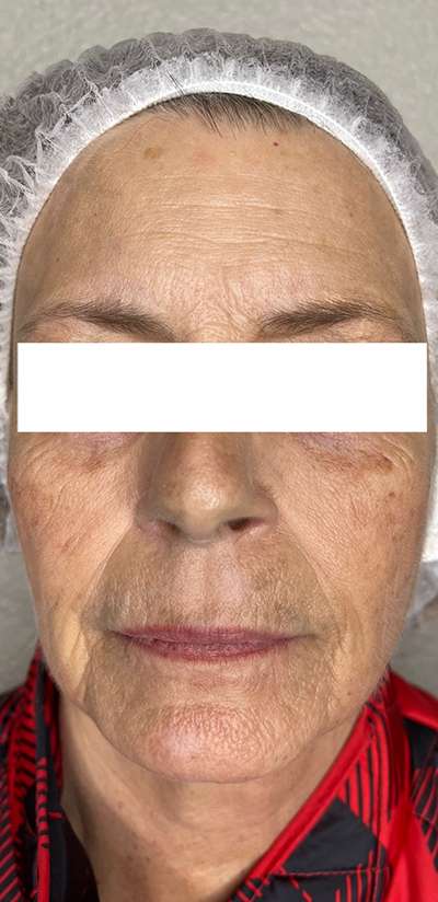 PDO Thread Lift Before & After Photos