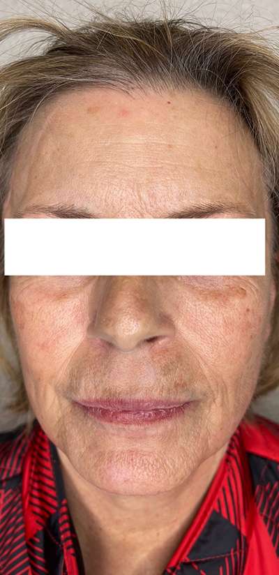 PDO Thread Lift Before & After Photos
