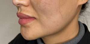 PDO Thread Lift Before & After Photos