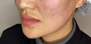 PDO Thread Lift Before & After Photos