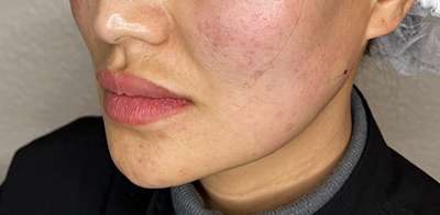 PDO Thread Lift Before & After Photos
