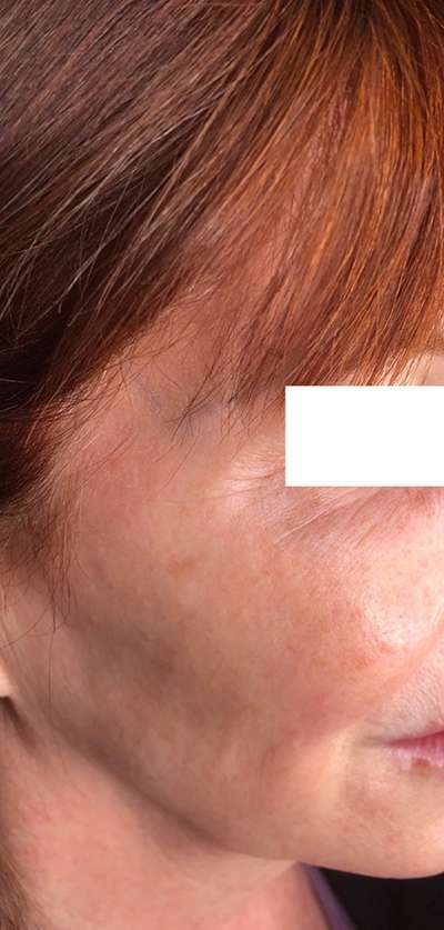 PDO Thread Lift Before & After Photos