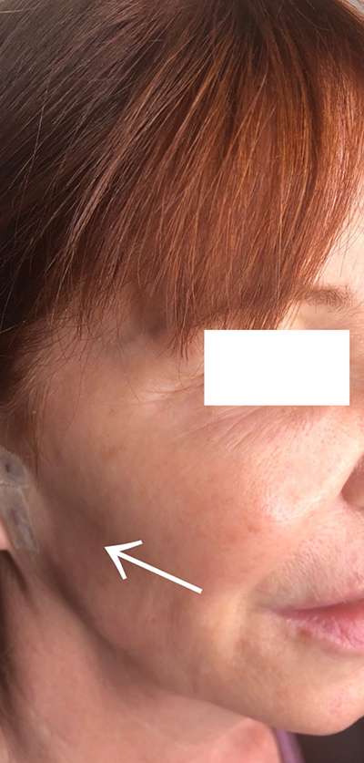 PDO Thread Lift Before & After Photos