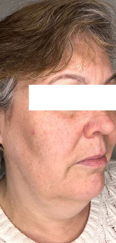 PDO Thread Lift Before & After Photos