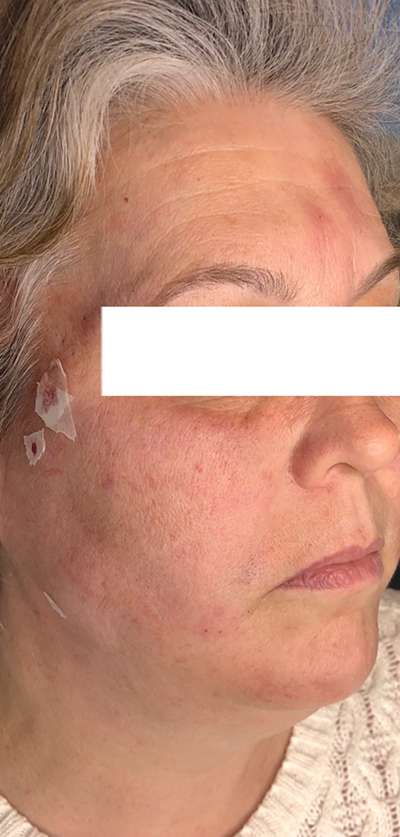 PDO Thread Lift Before & After Photos