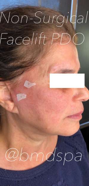 PDO Thread Lift Before & After Photos